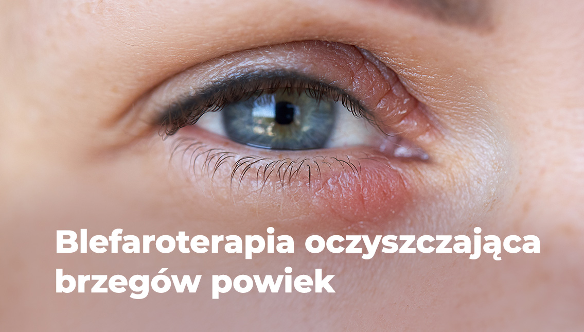 Blefaroterapia oczyszczająca NuLids